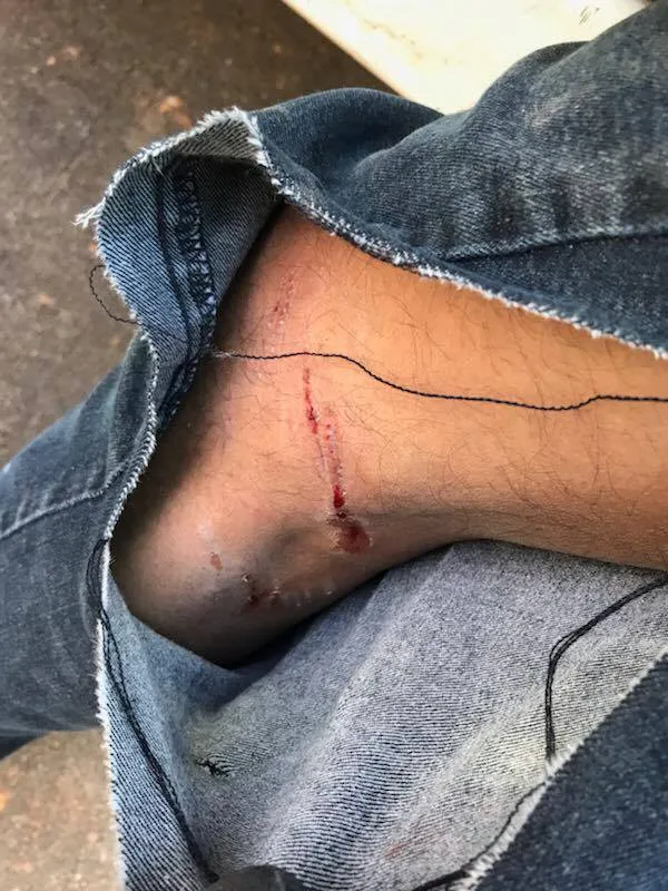 Outdoor Living Tip of the Day – Dog Bites